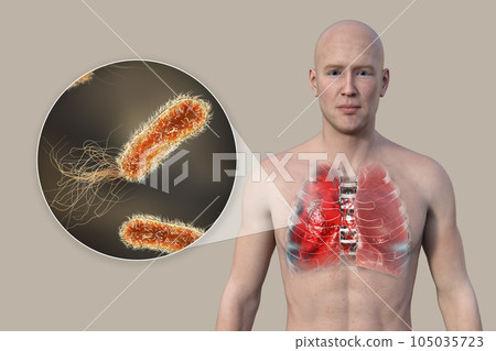 A 3D illustration showcasing the upper half part of a man with transparent skin, revealing the lungs affected by pneumonia 105035723