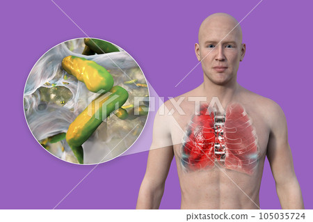 A 3D illustration showcasing the upper half part of a man with transparent skin, revealing the lungs affected by pneumonia A 3D illustration showcasing the upper half part of a man with transparent skin, revealing the lungs affected by pneumonia 105035724