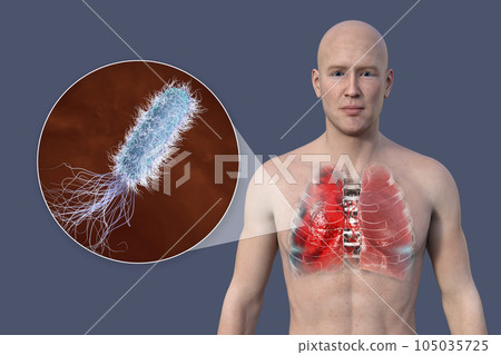 A 3D illustration showcasing the upper half part of a man with transparent skin, revealing the lungs affected by pneumonia A 3D illustration showcasing the upper half part of a man with transparent skin, revealing the lungs affected by pneumonia 105035725