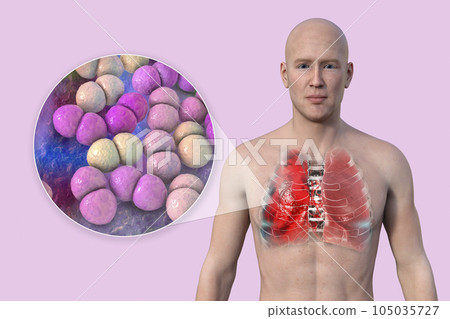 A 3D illustration showcasing the upper half part of a man with transparent skin, revealing the lungs affected by pneumonia A 3D illustration showcasing the upper half part of a man with transparent skin, revealing the lungs affected by pneumonia 105035727