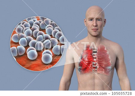 A 3D illustration showcasing the upper half part of a man with transparent skin, revealing the lungs affected by pneumonia A 3D illustration showcasing the upper half part of a man with transparent skin, revealing the lungs affected by pneumonia 105035728