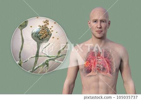 A 3D illustration of the upper half part of a man with transparent skin, revealing a lung mucormycosis lesion, with close-up view of Rhizopus fungi A 3D illustration of the upper half part of a man with transparent skin, revealing a lung mucormycosis lesion, with close-up view of Rhizopus fungi 105035737
