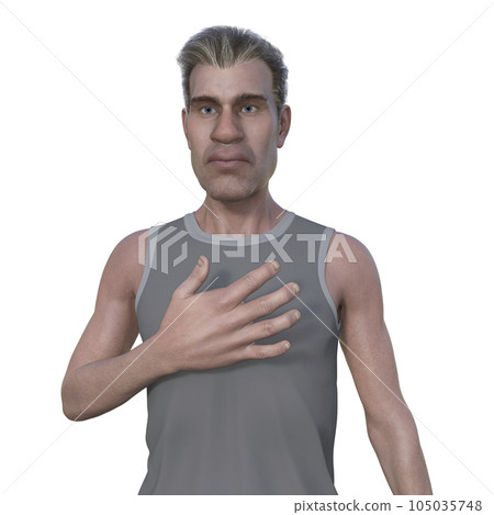 A man suffering from acromegaly, 3D illustration A man suffering from acromegaly, 3D illustration 105035748