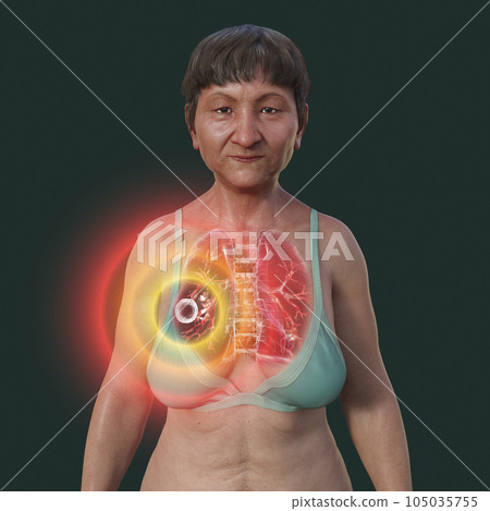 A 3D illustration of the upper half of a female patient with transparent skin, showcasing the lungs affected by cavernous tuberculosis A 3D illustration of the upper half of a female patient with transparent skin, showcasing the lungs affected by cavernous tuberculosis 105035755