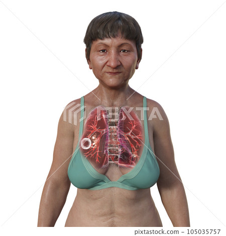 A 3D illustration of the upper half of a female patient with transparent skin, showcasing the lungs affected by cavernous tuberculosis A 3D illustration of the upper half of a female patient with transparent skin, showcasing the lungs affected by cavernous tuberculosis 105035757