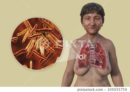 A 3D illustration of the upper half of a female patient with transparent skin, showcasing the lungs affected by cavernous tuberculosis 105035759