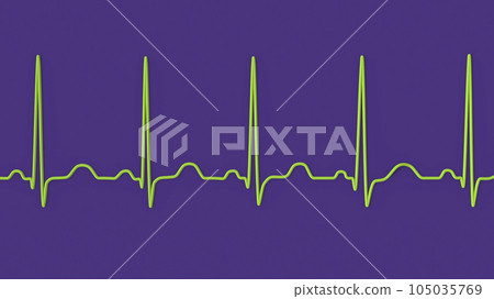 Electrocardiogram ECG displaying sinus tachycardia, 3D illustration 105035769