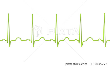 Electrocardiogram ECG displaying sinus tachycardia, 3D illustration 105035773
