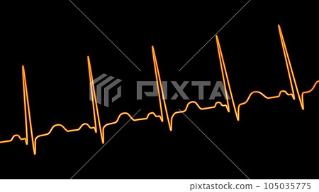 Electrocardiogram ECG displaying sinus tachycardia, 3D illustration 105035775