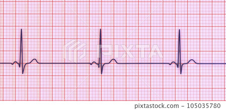 Electrocardiogram ECG displaying sinus bradycardia, 3D illustration 105035780