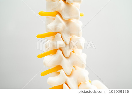 Lumbar spine displaced herniated disc fragment, spinal nerve and bone. Model for treatment medical in the orthopedic department. 105039126