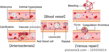 血管動脈硬化血管修復圖解英文 105050814