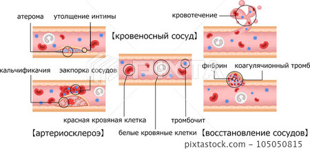 Blood vessel arteriosclerosis blood vessel repair illustration Russian Blood vessel arteriosclerosis blood vessel repair illustration Russian 105050815