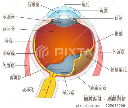 Eyeball, retinal tear, retinal detachment, retinal tear, retinal detachment, illustration 105056906