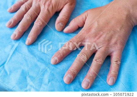 Psoriasis on the hands of a man. Dry male hand on a blue background. Hike to the doctor, treatment of eczema and psoriasis. 105071922