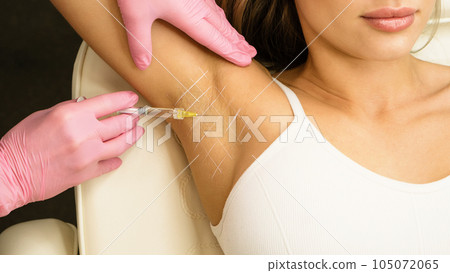 Treatment hyperhidrosis botulinum toxin 105072065