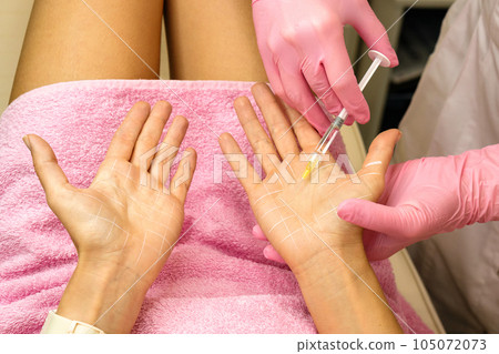 Treatment hyperhidrosis botulinum toxin 105072073