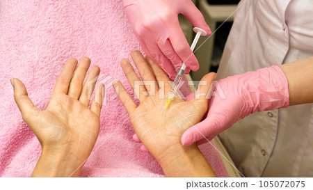 Treatment hyperhidrosis botulinum toxin 105072075