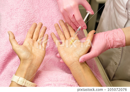 Treatment hyperhidrosis botulinum toxin 105072076