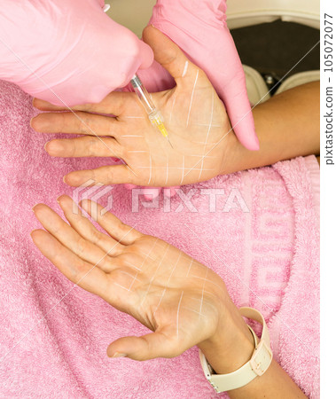 Treatment hyperhidrosis botulinum toxin Treatment hyperhidrosis botulinum toxin 105072077