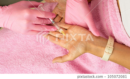 Treatment hyperhidrosis botulinum toxin Treatment hyperhidrosis botulinum toxin 105072081