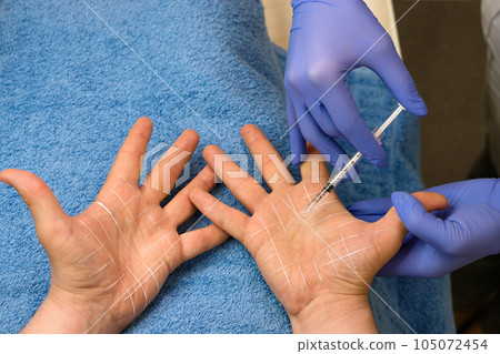 Treatment hyperhidrosis botulinum toxin Treatment hyperhidrosis botulinum toxin 105072454
