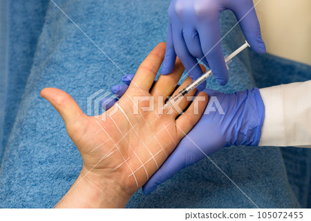 Treatment hyperhidrosis botulinum toxin Treatment hyperhidrosis botulinum toxin 105072455