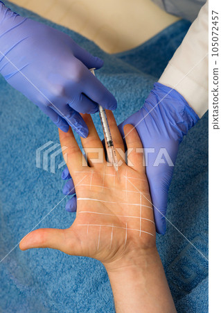 Treatment hyperhidrosis botulinum toxin 105072457