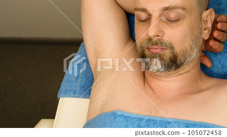 Treatment hyperhidrosis botulinum toxin Treatment hyperhidrosis botulinum toxin 105072458