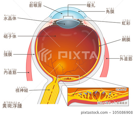 Eyeball, macular edema, macular edema, illustration, eye, illustration 105086908