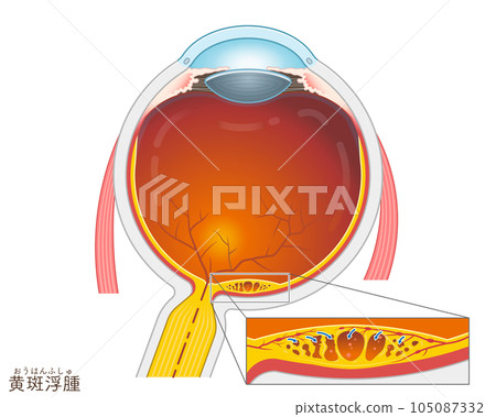 Eyeball, macular edema, macular edema, illustration, eye, illustration 105087332