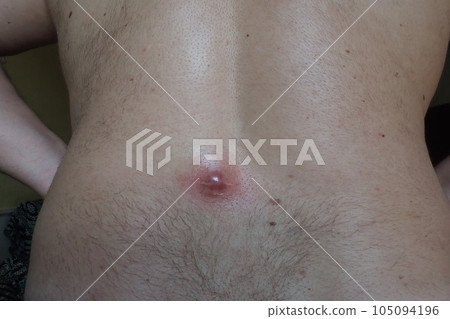 Abscess furuncle carbuncle on male hairy back. Clogged pore leading to skin inflammation. Surgical solution of cosmetic problems. Redness, swelling and pimple formation. Dermatology and surgery 105094196