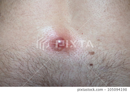 Abscess furuncle carbuncle on male hairy back. Clogged pore leading to skin inflammation. Surgical solution of cosmetic problems. Redness, swelling and pimple formation. Dermatology and surgery Abscess furuncle carbuncle on male hairy back. Clogged pore leading to skin inflammation. Surgical solution of cosmetic problems. Redness, swelling and pimple formation. Dermatology and surgery 105094198
