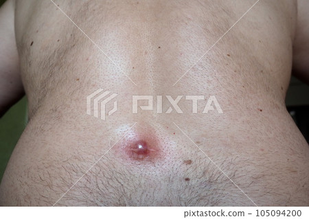 Abscess furuncle carbuncle on male hairy back. Clogged pore leading to skin inflammation. Surgical solution of cosmetic problems. Redness, swelling and pimple formation. Dermatology and surgery Abscess furuncle carbuncle on male hairy back. Clogged pore leading to skin inflammation. Surgical solution of cosmetic problems. Redness, swelling and pimple formation. Dermatology and surgery 105094200