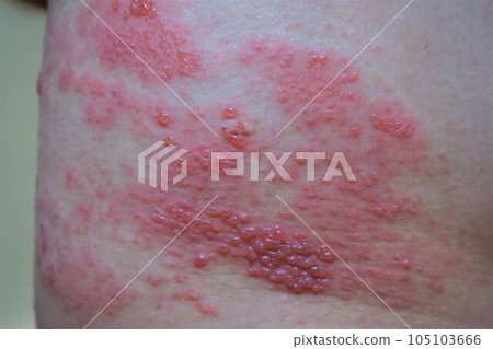 Herpes zoster, pain, lower back and buttocks, male Herpes zoster, pain, lower back and buttocks, male 105103666