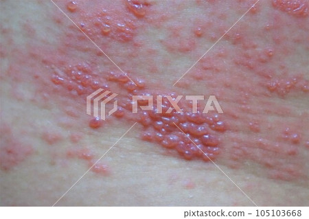 Herpes zoster, pain, lower back and buttocks, male Herpes zoster, pain, lower back and buttocks, male 105103668