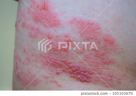 帶狀皰疹,疼痛,下背部和臀部,男性 帶狀皰疹,疼痛,下背部和臀部,男性 105103670