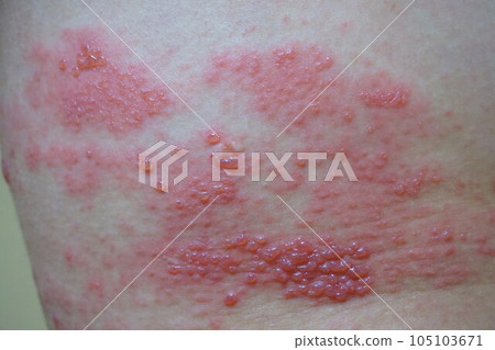 Herpes zoster, pain, lower back and buttocks, male Herpes zoster, pain, lower back and buttocks, male 105103671