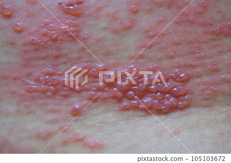 帶狀皰疹，疼痛，下背部和臀部，男性 105103672