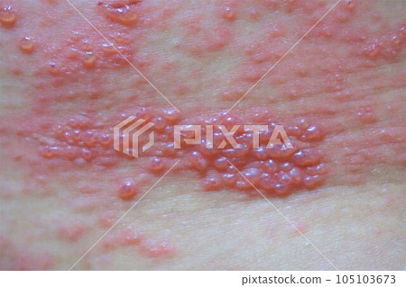 Herpes zoster, pain, lower back and buttocks, male 105103673