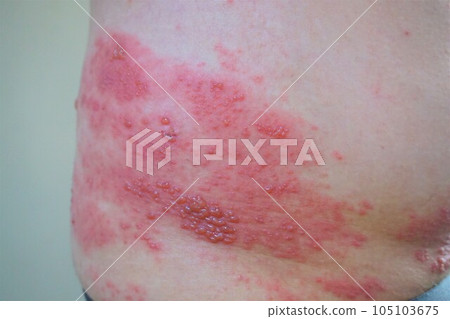 帶狀皰疹,疼痛,下背部和臀部,男性 帶狀皰疹,疼痛,下背部和臀部,男性 105103675