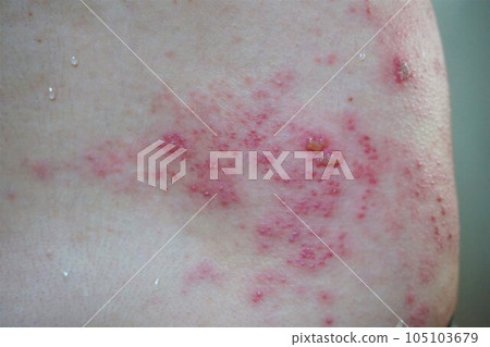 Herpes zoster, pain, lower back and buttocks, male 105103679