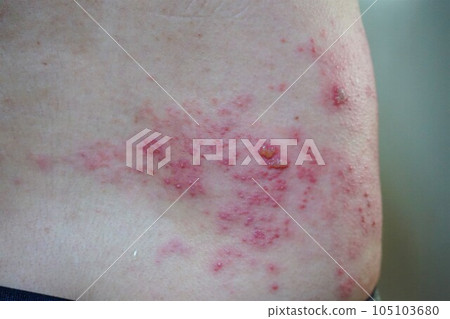 帶狀皰疹，疼痛，下背部和臀部，男性 105103680
