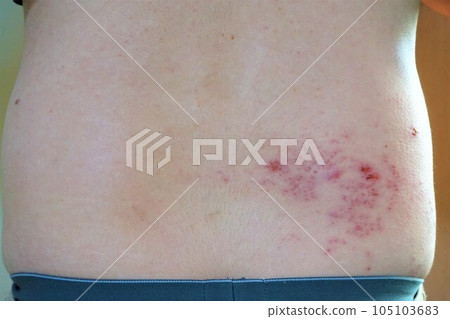 Herpes zoster, pain, lower back and buttocks, male Herpes zoster, pain, lower back and buttocks, male 105103683