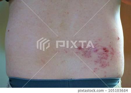Herpes zoster, pain, lower back and buttocks, male 105103684