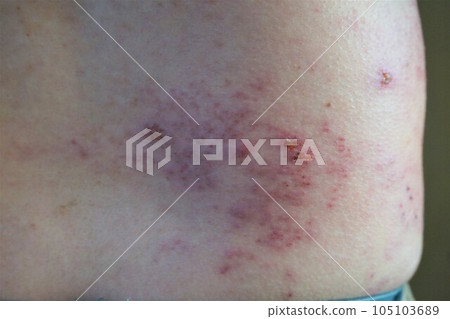 帶狀皰疹,疼痛,下背部和臀部,男性 帶狀皰疹,疼痛,下背部和臀部,男性 105103689