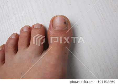 left leg, foot close-up with injured big toe, hematoma, bruising on the nail plate, nail of the big toe of the left foot. Injuries to the legs, nails, diseases of the legs, skin, nails. Podology left leg, foot close-up with injured big toe, hematoma, bruising on the nail plate, nail of the big toe of the left foot. Injuries to the legs, nails, diseases of the legs, skin, nails. Podology 105108869