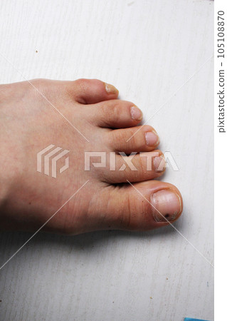 left leg, foot close-up with injured big toe, hematoma, bruising on the nail plate, nail of the big toe of the left foot. Injuries to the legs, nails, diseases of the legs, skin, nails. Podology left leg, foot close-up with injured big toe, hematoma, bruising on the nail plate, nail of the big toe of the left foot. Injuries to the legs, nails, diseases of the legs, skin, nails. Podology 105108870