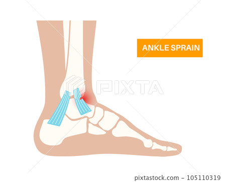 Sprained ankle injury Sprained ankle injury 105110319