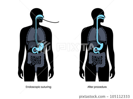 Endoscopic sleeve gastroplasty Endoscopic sleeve gastroplasty 105112333